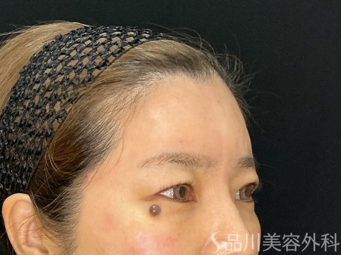 症例NO.71898のAFTER写真