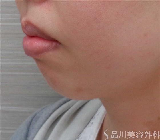 症例NO.60434のBEFORE写真