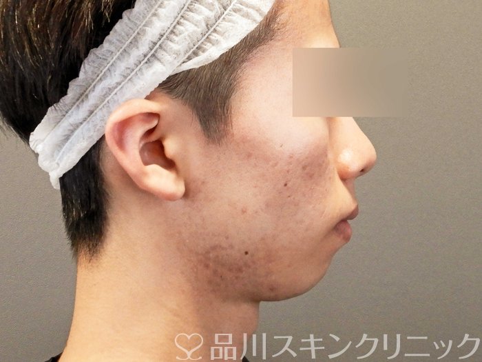 症例NO.68375のBEFORE写真