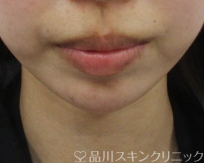 症例NO.64986のAFTER写真