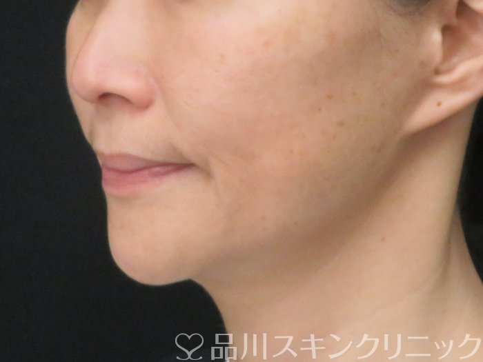 症例NO.69947のBEFORE写真