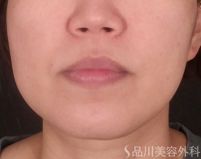 症例NO.71401のBEFORE写真