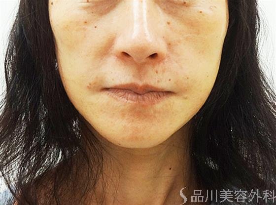 症例NO.30517のAFTER写真