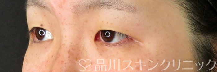 症例NO.74143のBEFORE写真