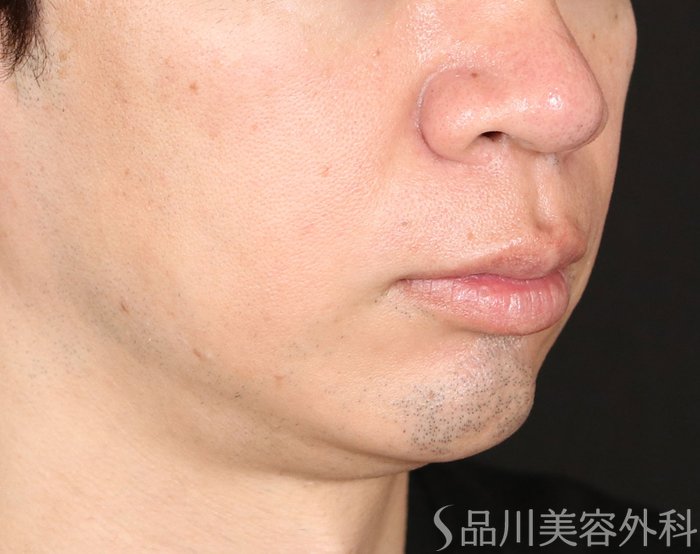 症例NO.71766のAFTER写真