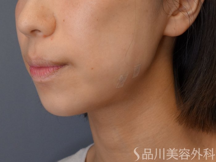 症例NO.72912のAFTER写真