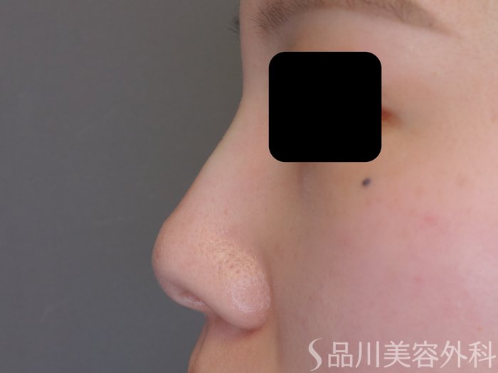 症例NO.69601のAFTER写真