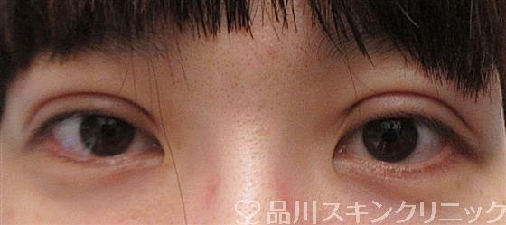 症例NO.27574のAFTER写真