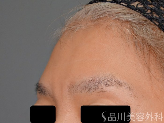 症例NO.70706のBEFORE写真