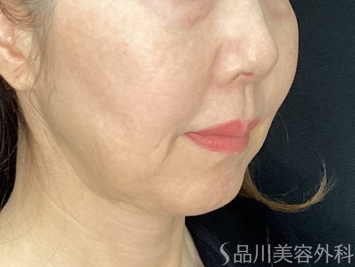 症例NO.72545のBEFORE写真