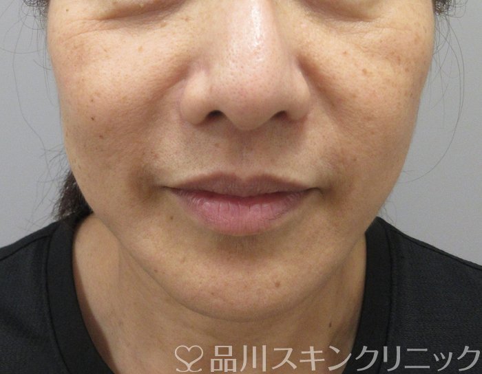 症例NO.74307のBEFORE写真