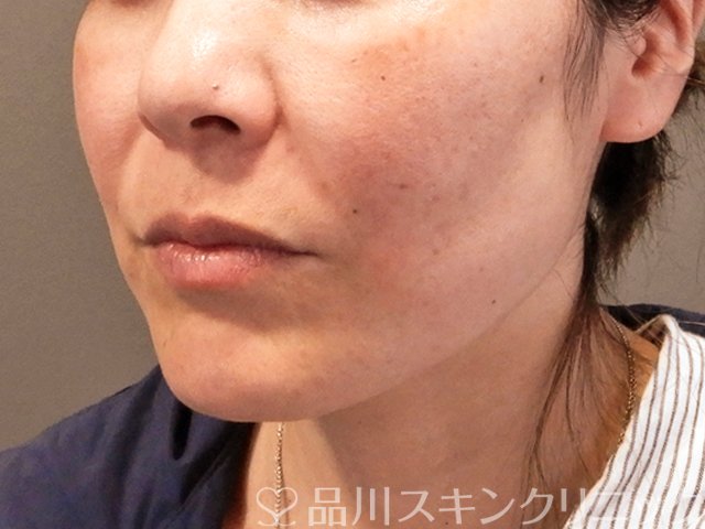 症例NO.70824のBEFORE写真