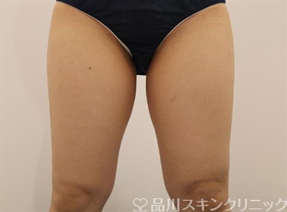 症例NO.42452のBEFORE写真