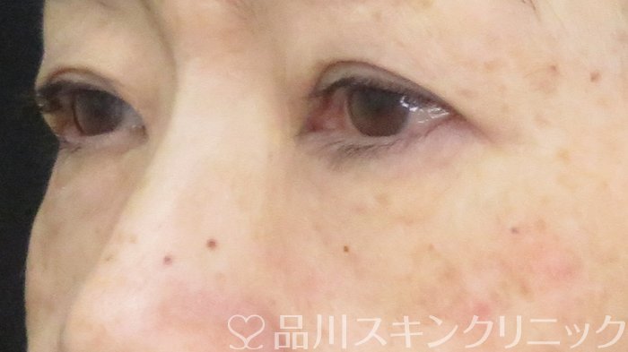 症例NO.71222のAFTER写真