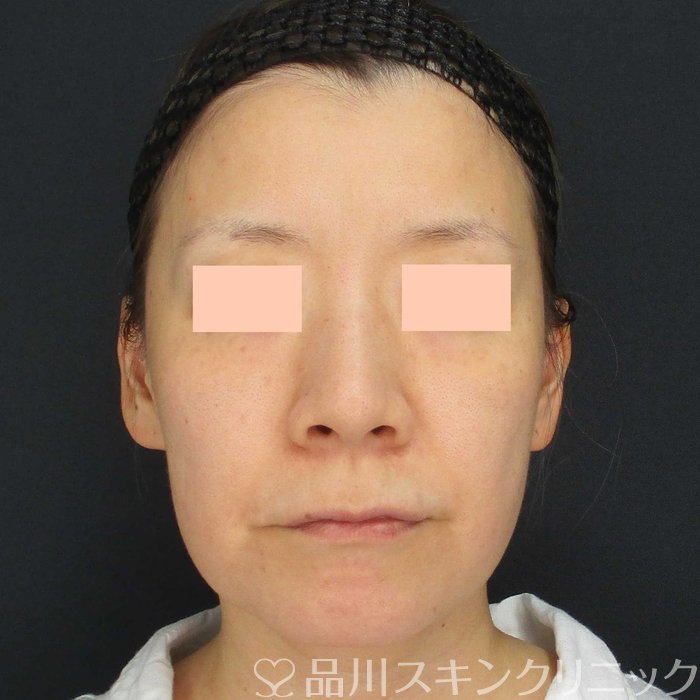 症例NO.67854のBEFORE写真