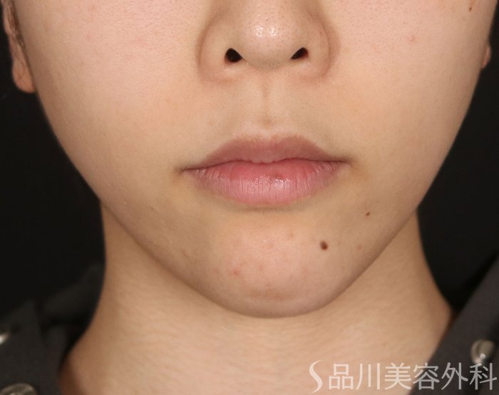 症例NO.73358のBEFORE写真