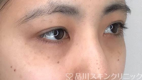 症例NO.59923のBEFORE写真