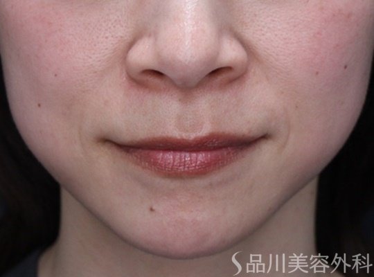 症例NO.69674のBEFORE写真