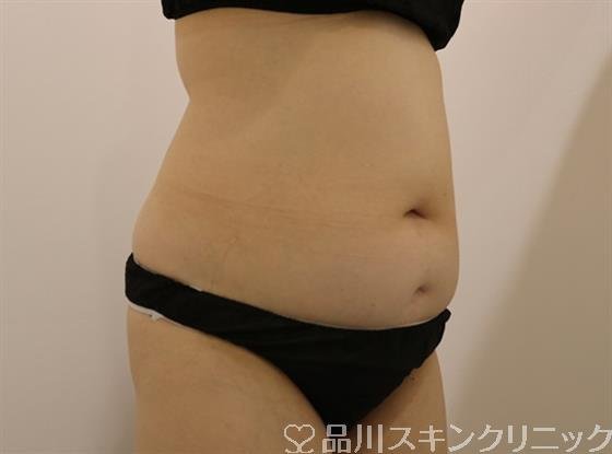 症例NO.44319のAFTER写真