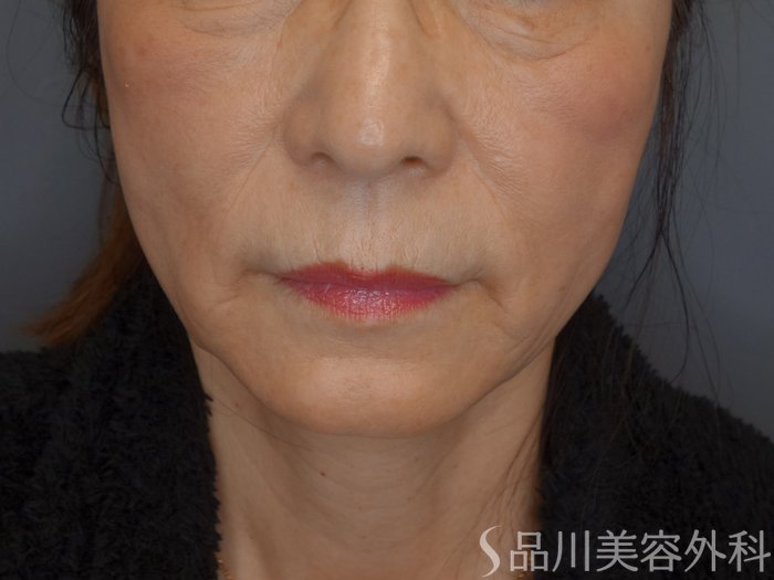 症例NO.75095のAFTER写真