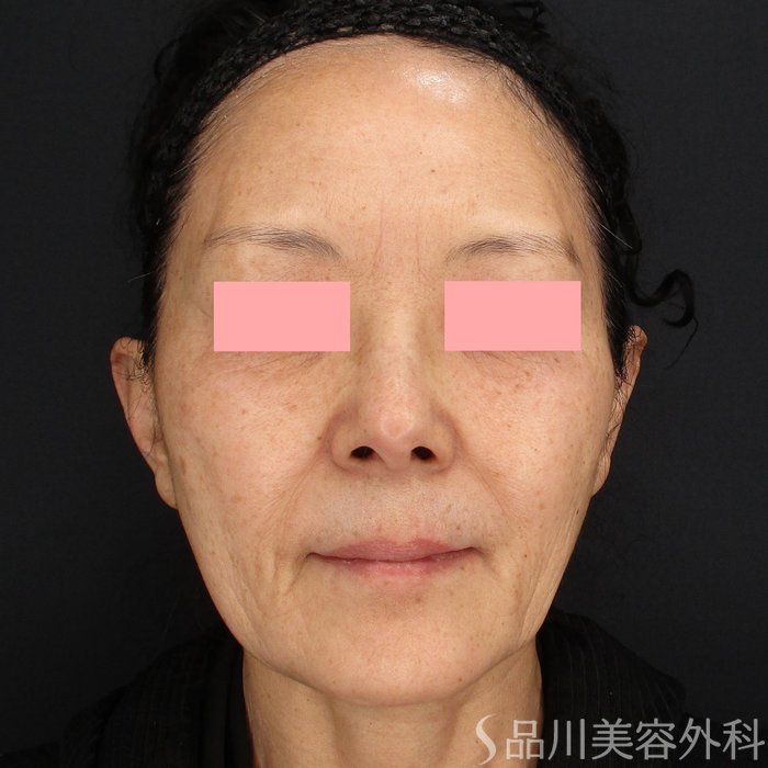 症例NO.70340のBEFORE写真