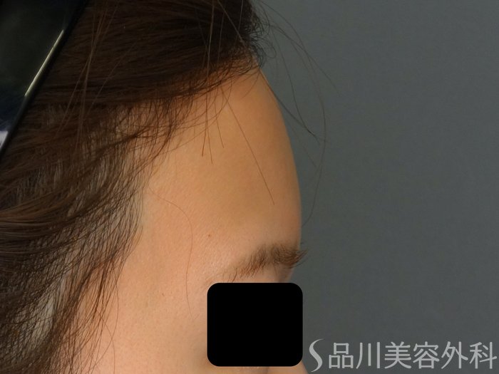 症例NO.69293のBEFORE写真