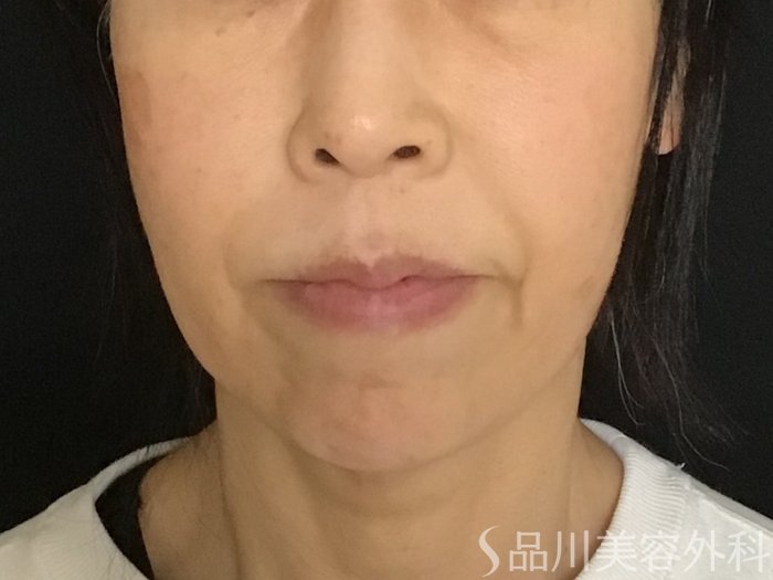 症例NO.65240のBEFORE写真