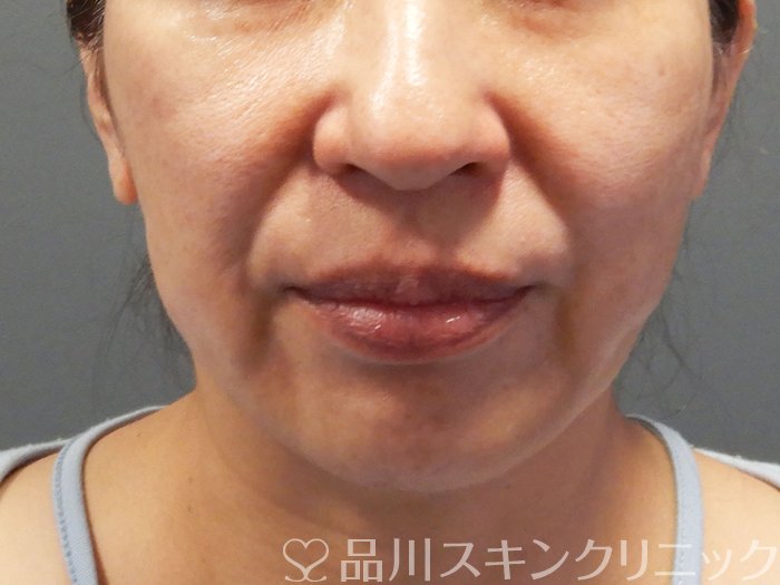 症例NO.70602のBEFORE写真