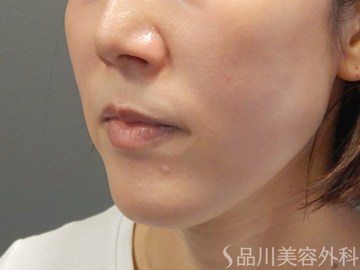 症例NO.71554のBEFORE写真