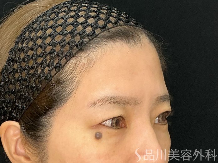 症例NO.71898のBEFORE写真