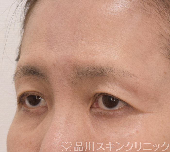 症例NO.71384のBEFORE写真