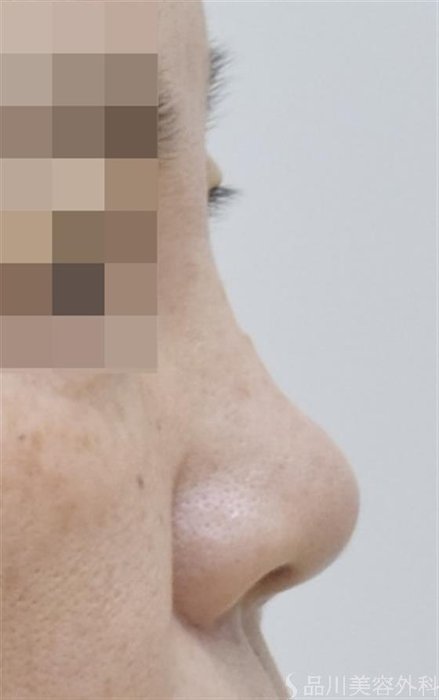 症例NO.51712のBEFORE写真