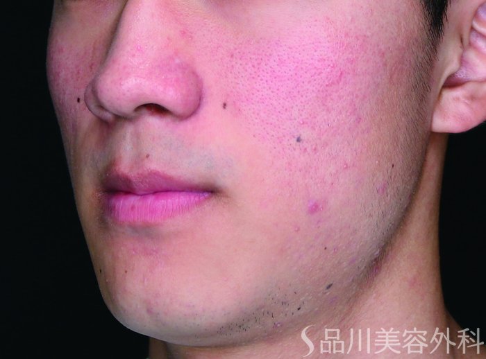 症例NO.71477のBEFORE写真