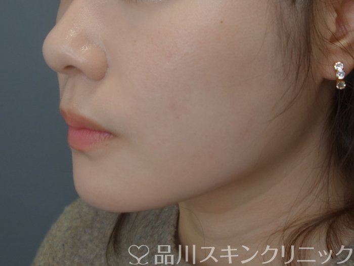 症例NO.73671のAFTER写真