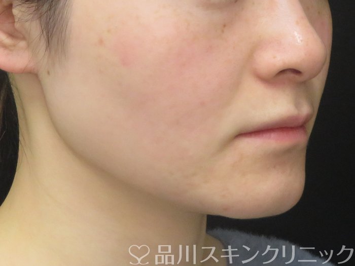 症例NO.74266のAFTER写真