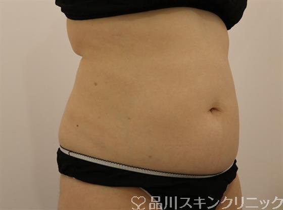 症例NO.44501のAFTER写真