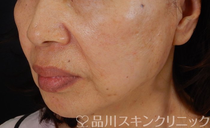 症例NO.65135のAFTER写真
