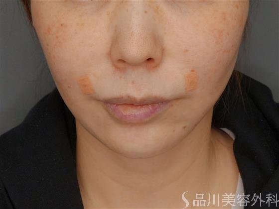 症例NO.59185のAFTER写真