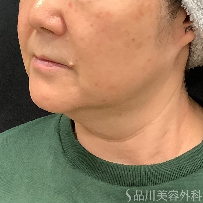 症例NO.75332のBEFORE写真