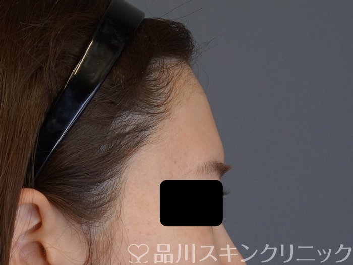 症例NO.74120のBEFORE写真