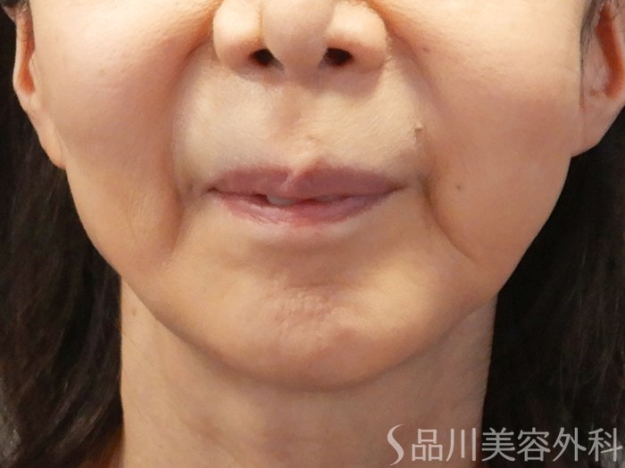 症例NO.71623のBEFORE写真