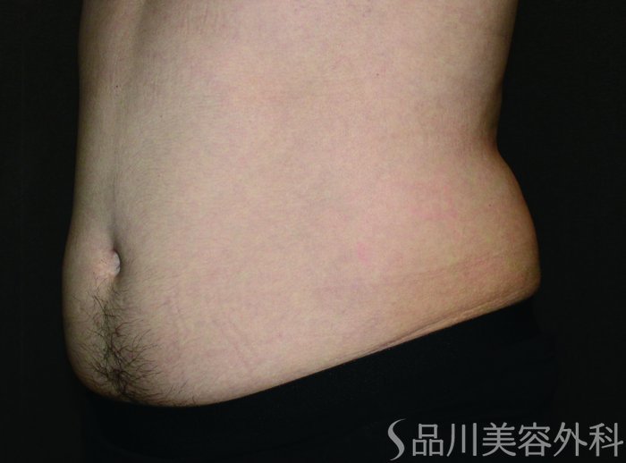 症例NO.71440のBEFORE写真