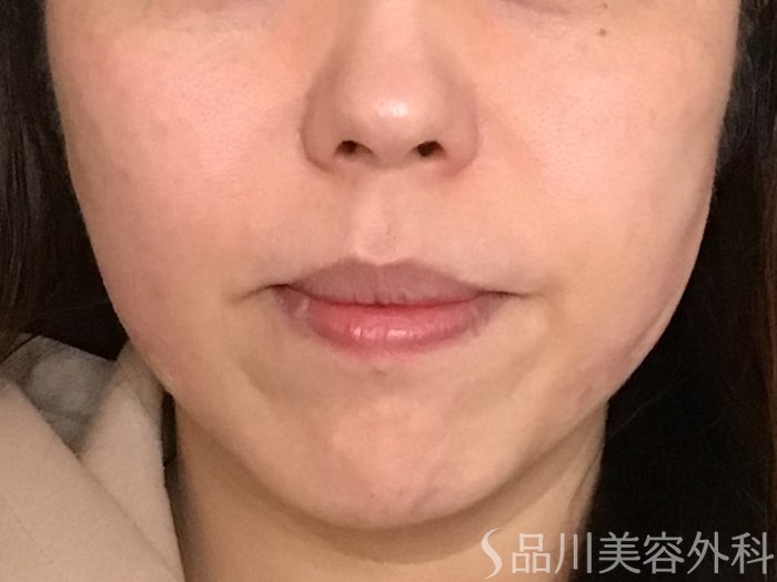 症例NO.65282のAFTER写真