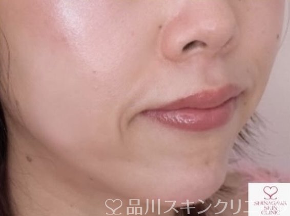 症例NO.68043のBEFORE写真