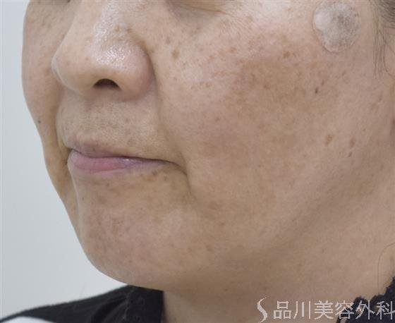 症例NO.48022のBEFORE写真