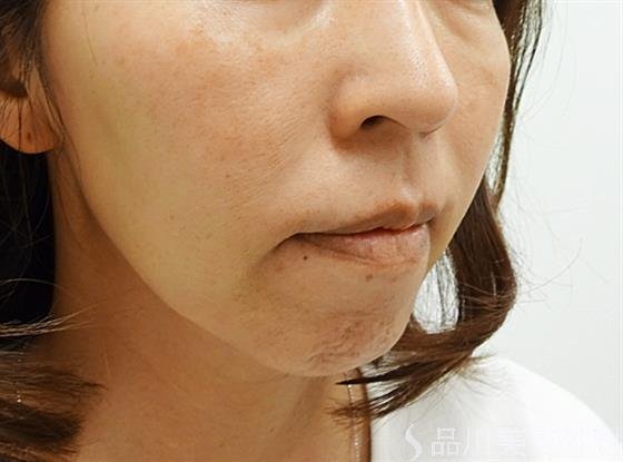 症例NO.36174のBEFORE写真