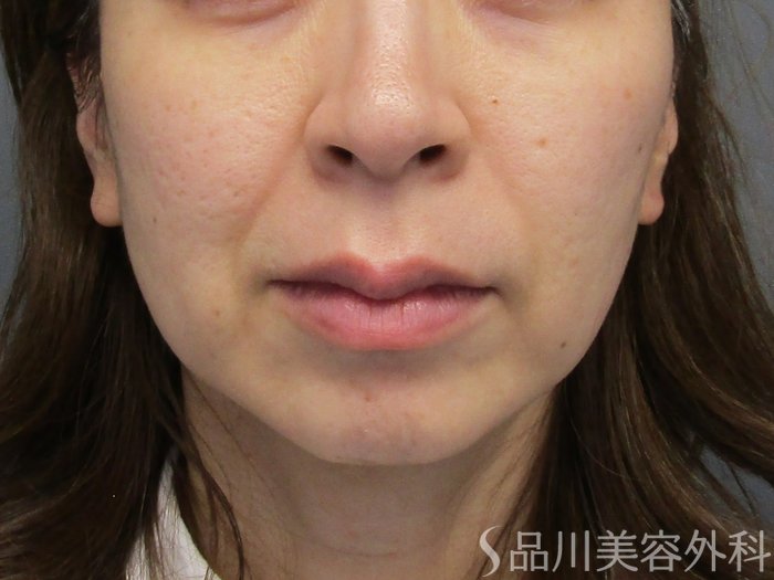 症例NO.75137のBEFORE写真