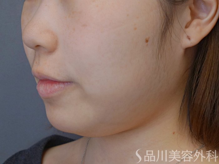 症例NO.73909のBEFORE写真