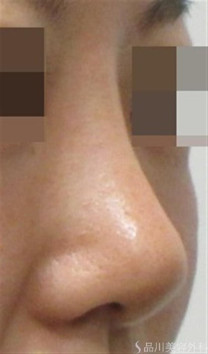症例NO.20341のAFTER写真