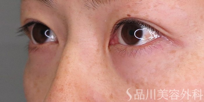 症例NO.71560のBEFORE写真